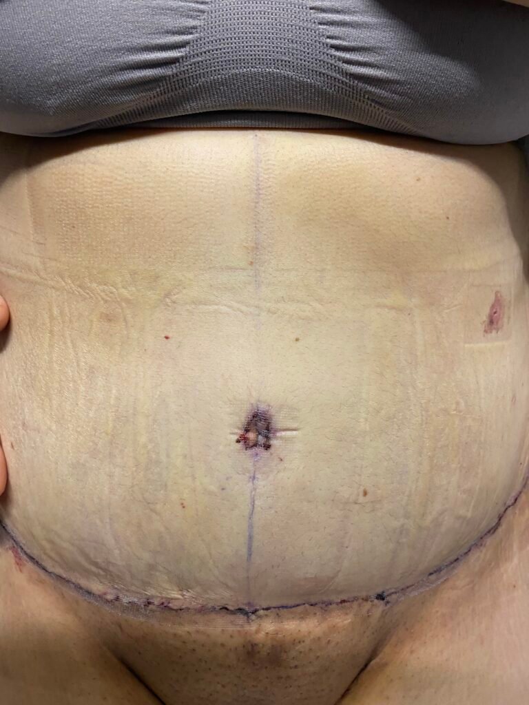 Tummy Tuck B8