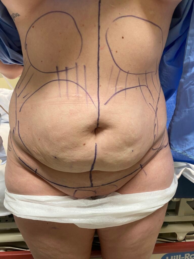 Tummy Tuck marking C1