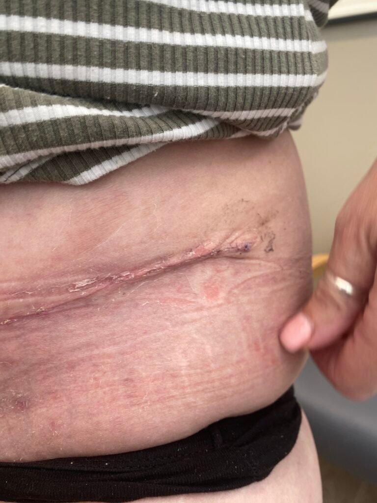 Tummy Tuck C12