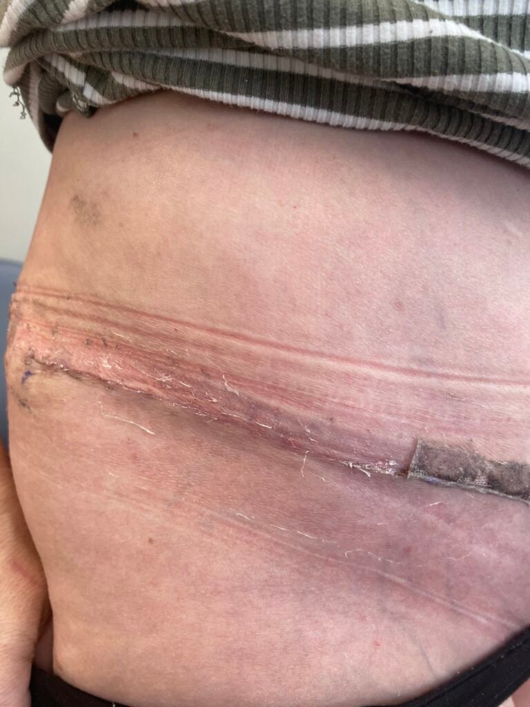 Tummy Tuck C13