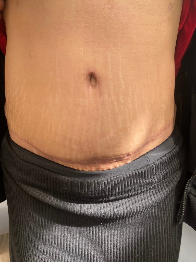 Tummy Tuck C17