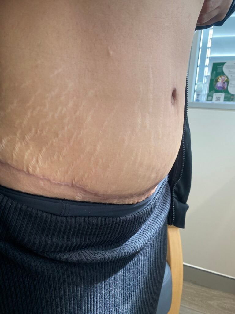 Tummy Tuck C18