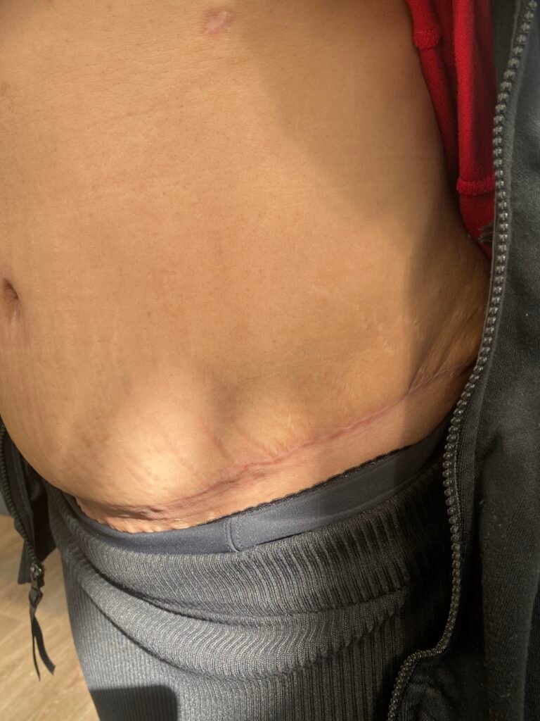 Tummy Tuck C19
