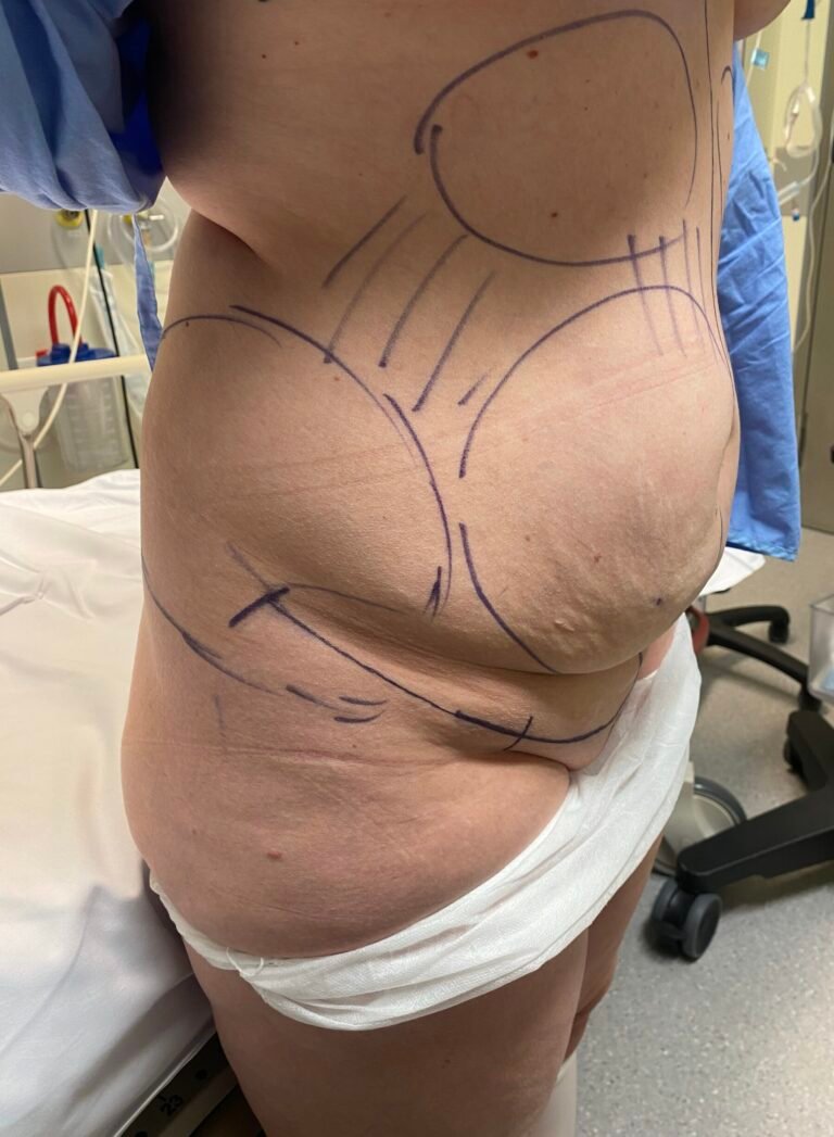 Tummy Tuck C2