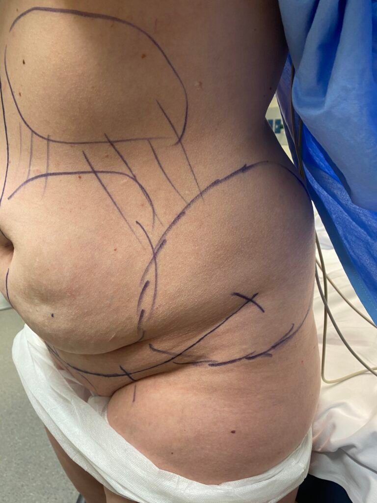 Tummy Tuck C3