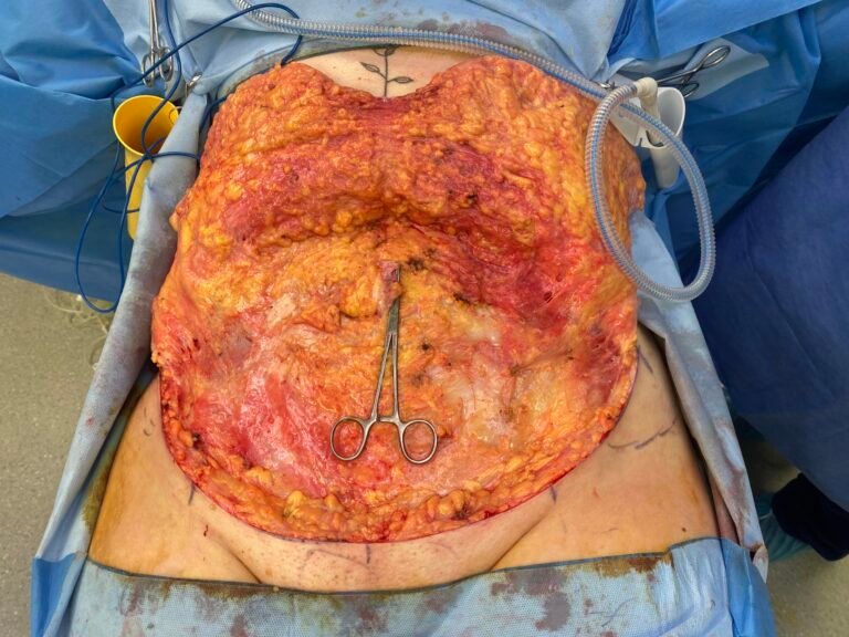 Tummy Tuck C4