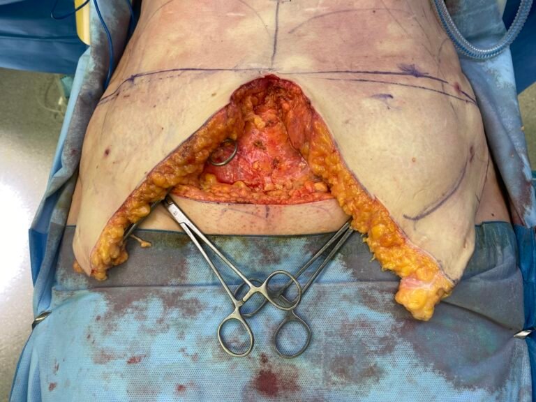 Tummy Tuck C5