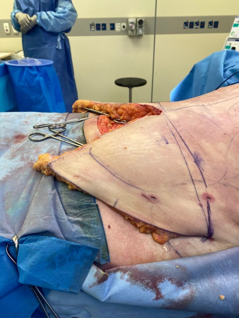 Tummy Tuck C6