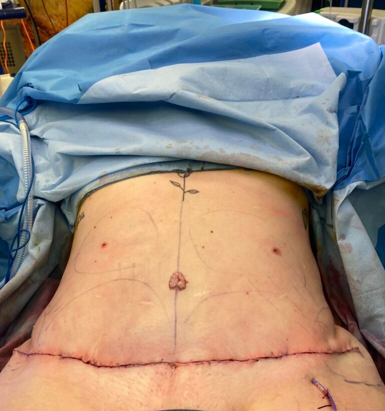 Tummy Tuck C8