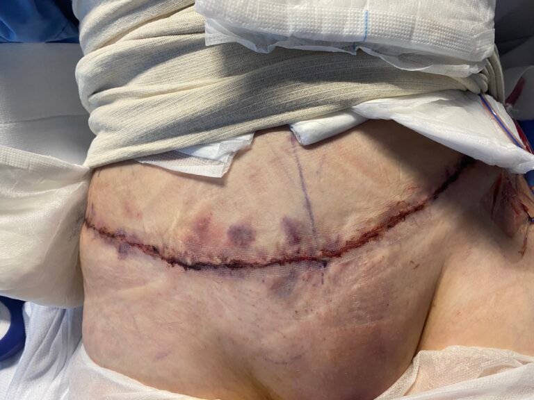 Tummy Tuck C9