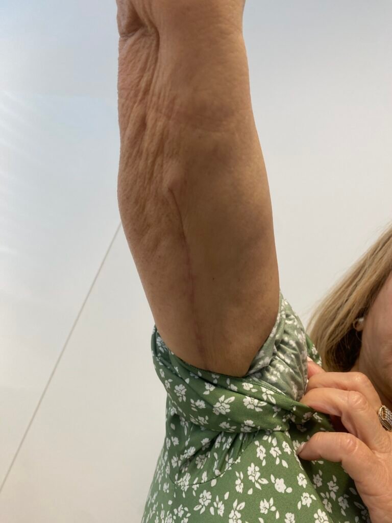 arm lift 1 month c9