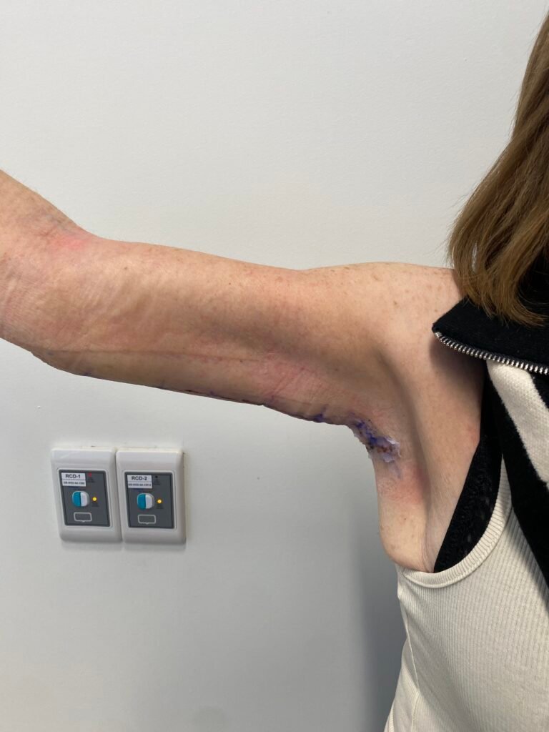 arm lift 1 week c6