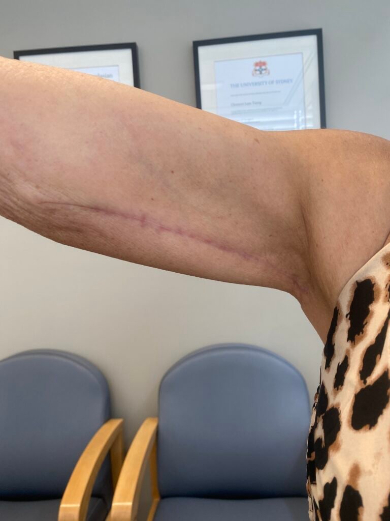 arm lift 2 months c8