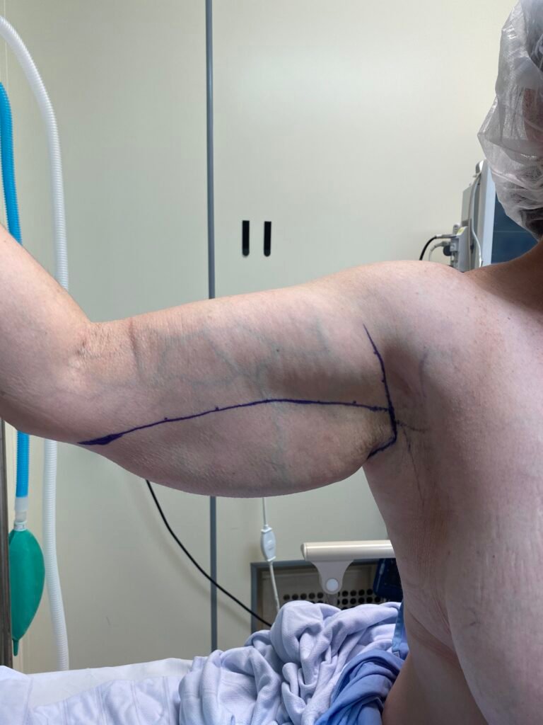 arm lift A1