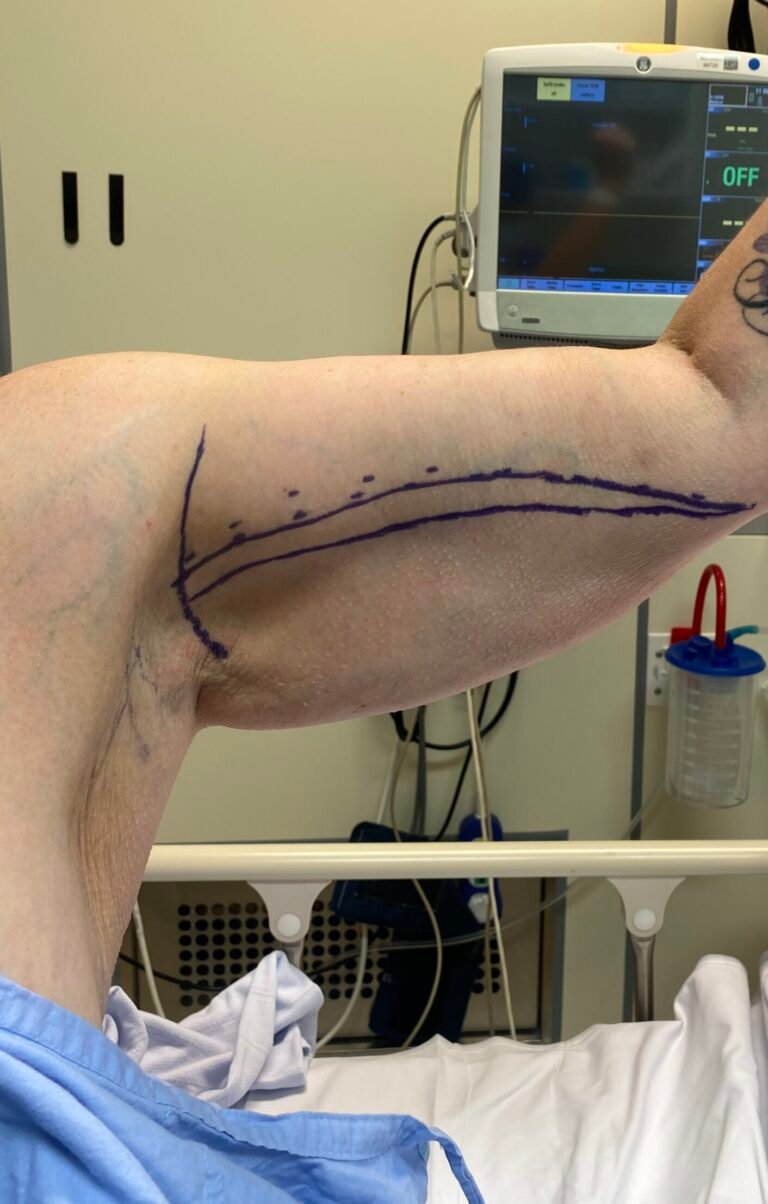 arm lift A2