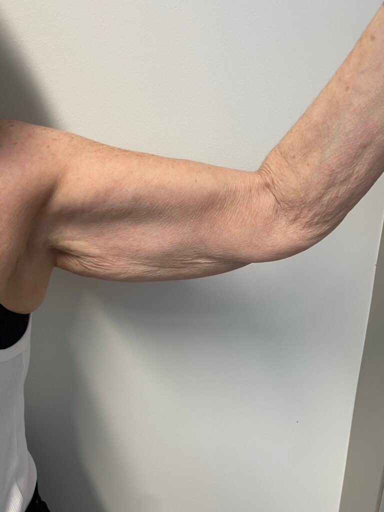 arm lift D1