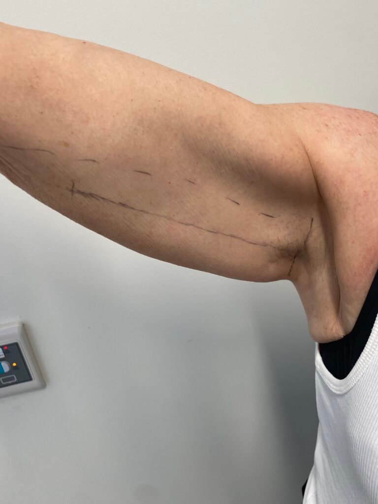arm lift D2