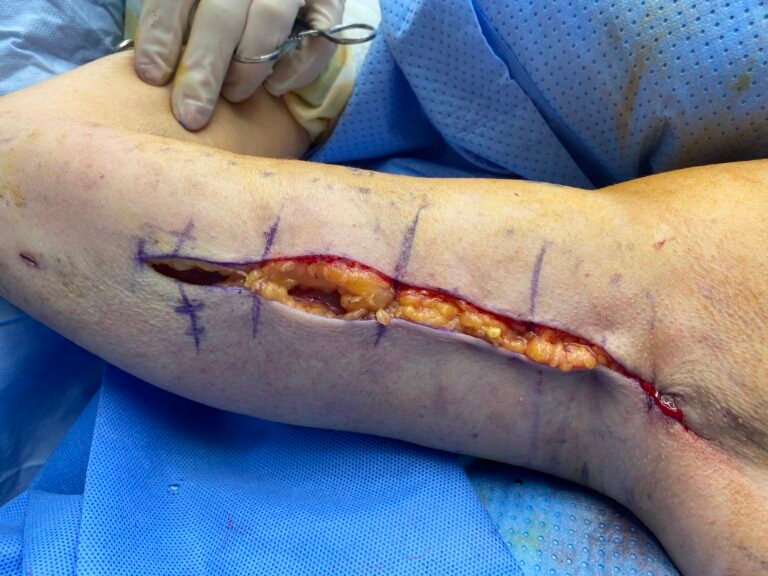 arm lift after skin removal c3