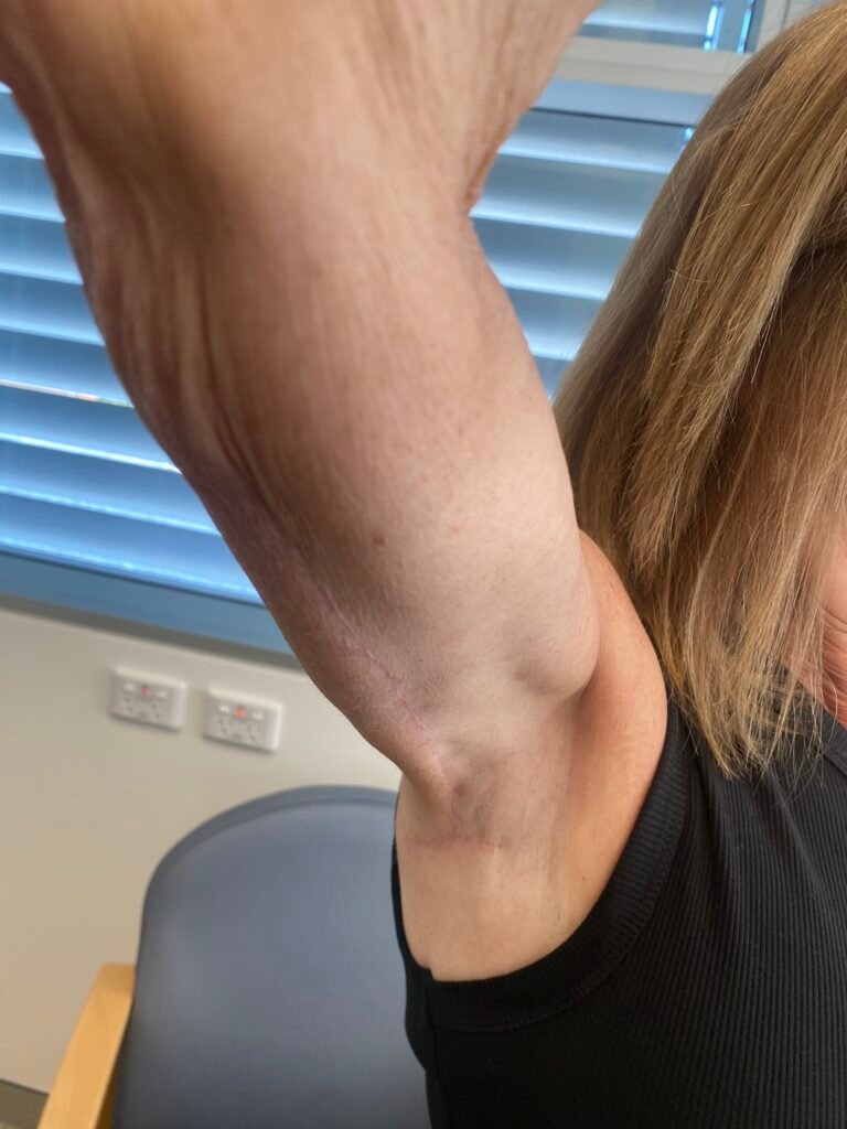 arm lift d10