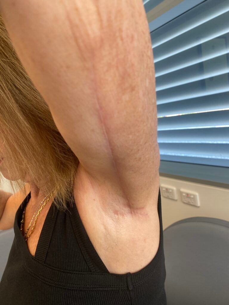 arm lift d11