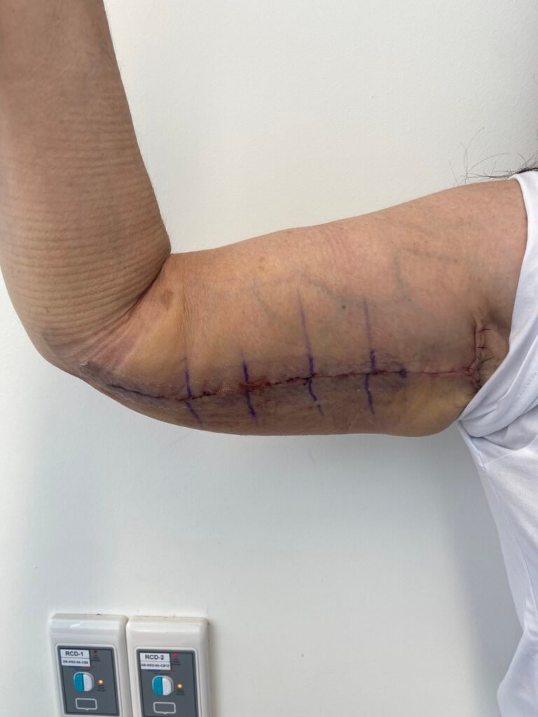 arm lift A7