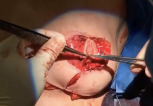 breast reduction 12
