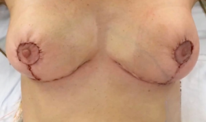 breast reduction 13