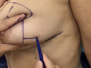 breast reduction 6