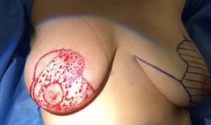 breast reduction 8