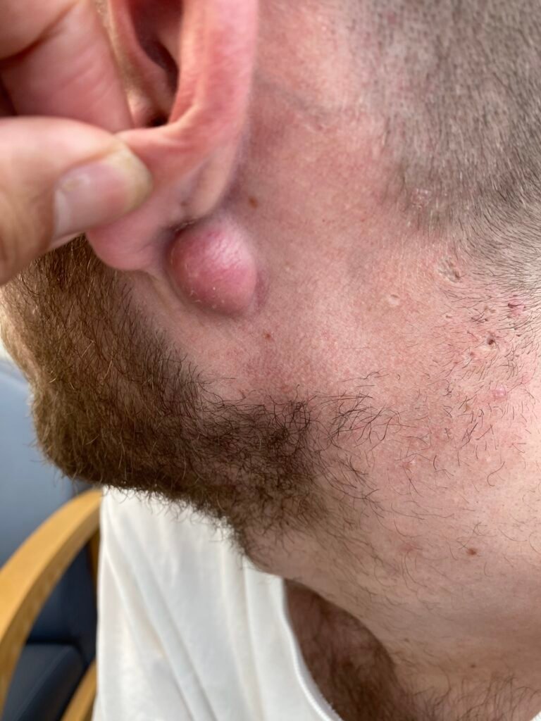 cyst behind ear