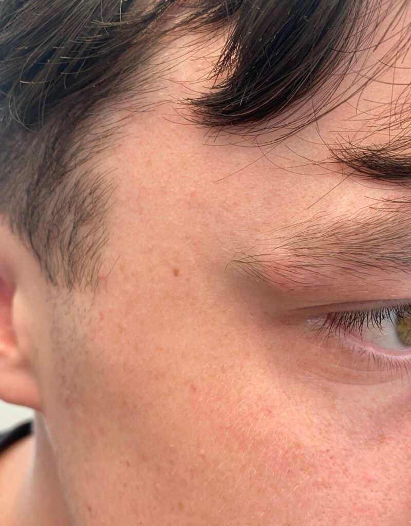 cyst brow