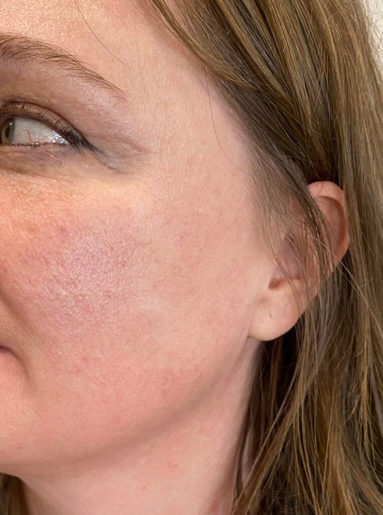 cyst face small