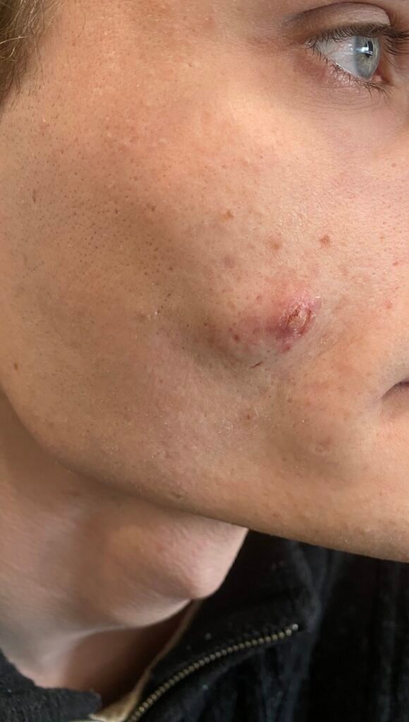 cyst face ulcerated