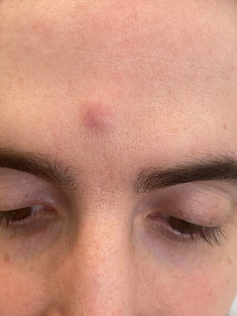 cyst forehead
