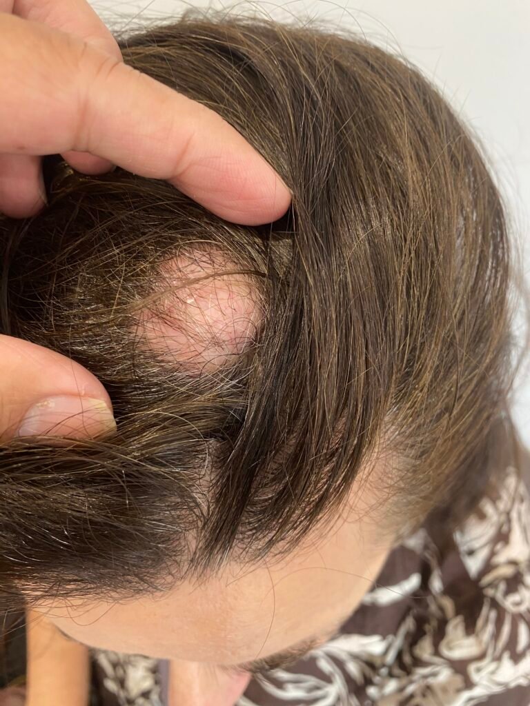cyst scalp 1