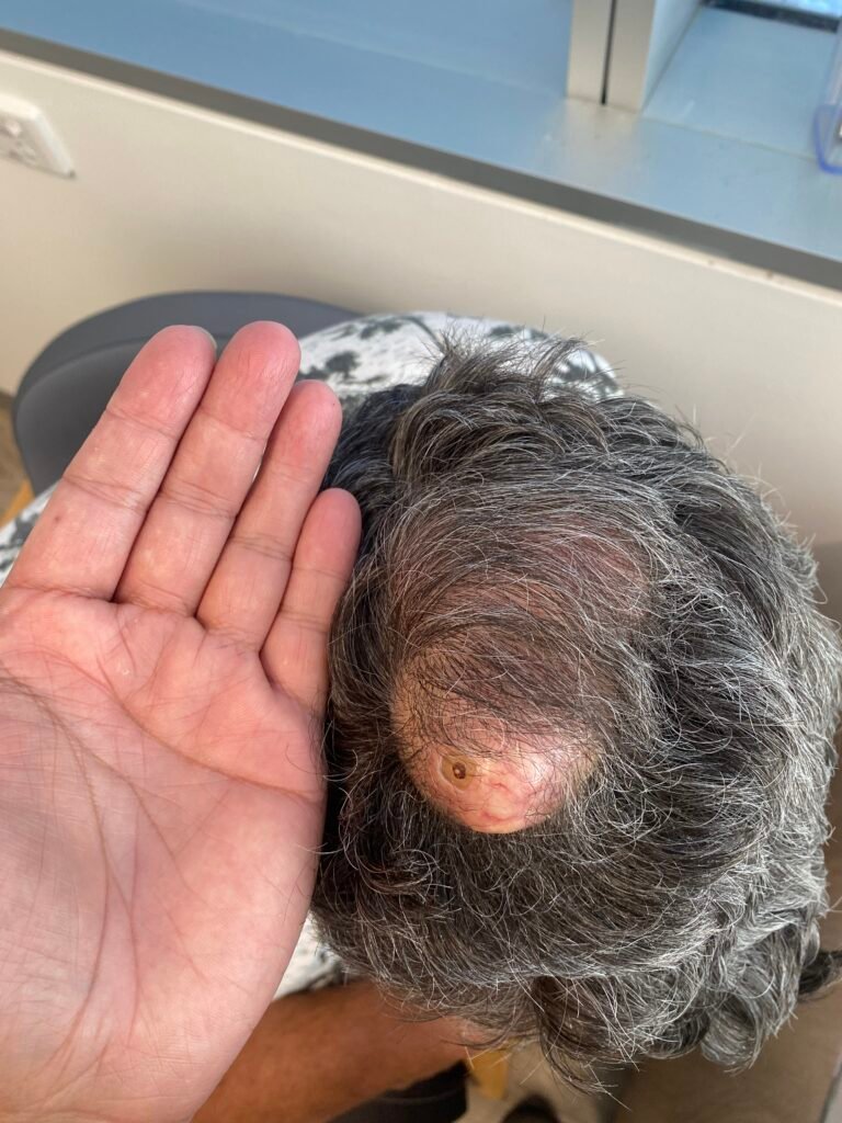 cyst scalp large
