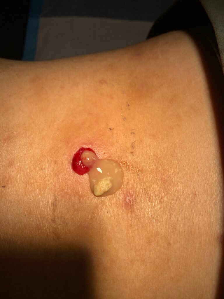 discharging cyst arm