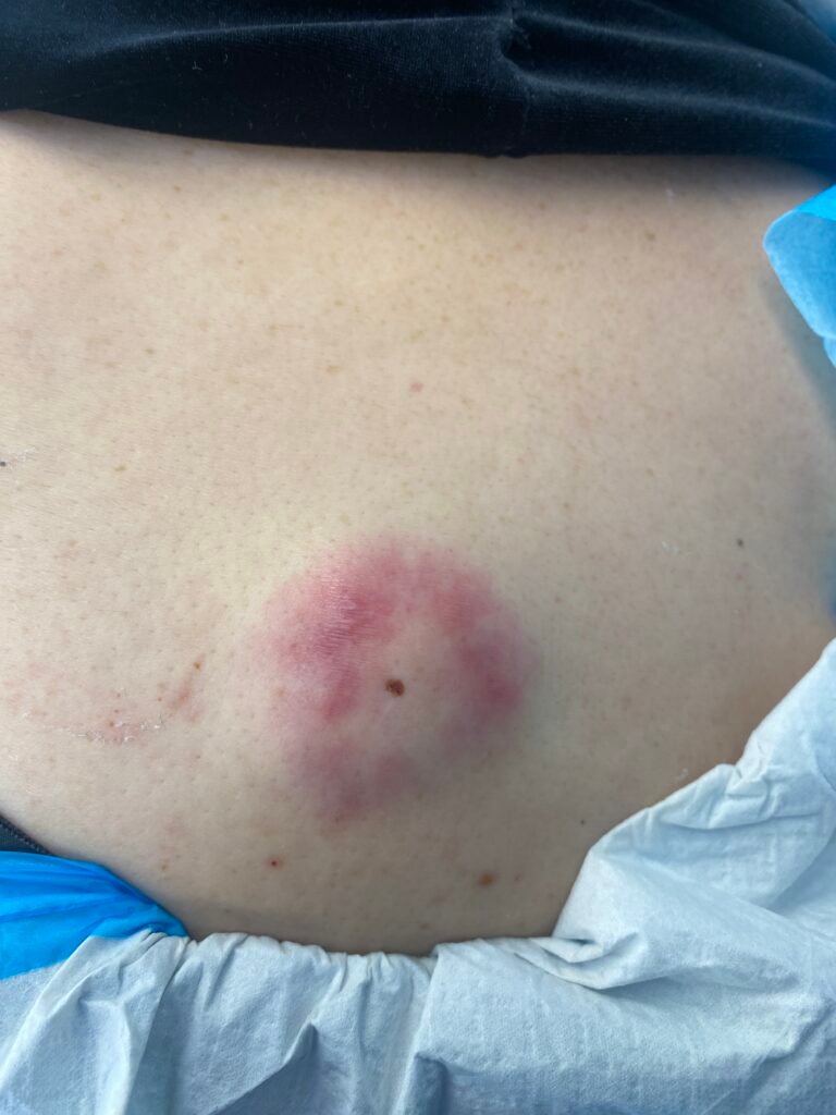 infected cyst 2