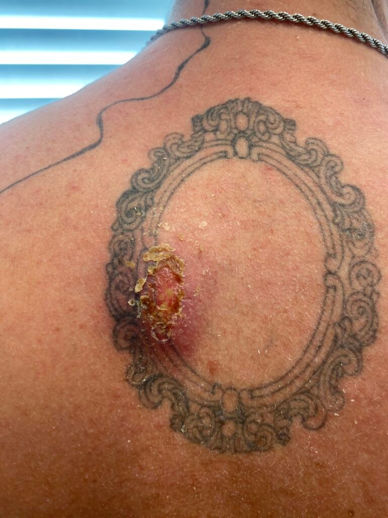 infected cyst back