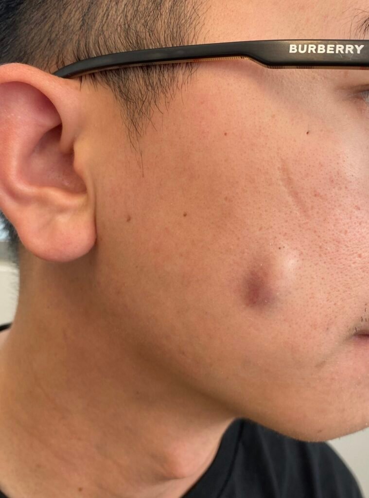infected cyst face