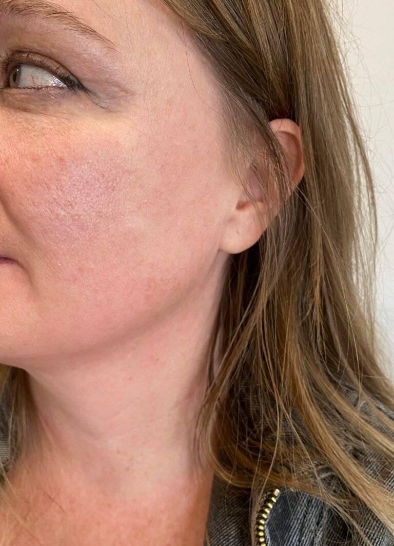cyst face