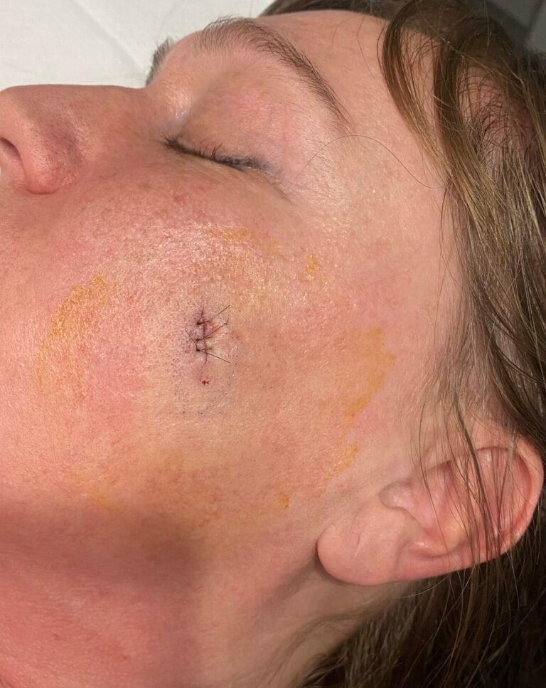 cyst face removed