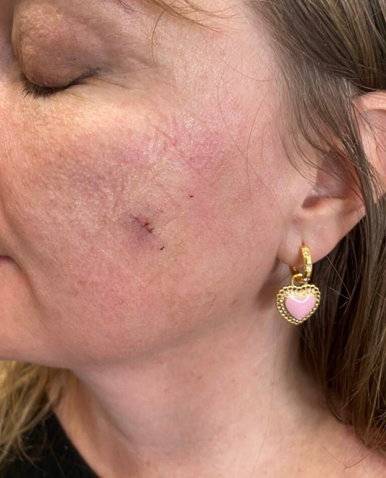 cyst face one week suture out