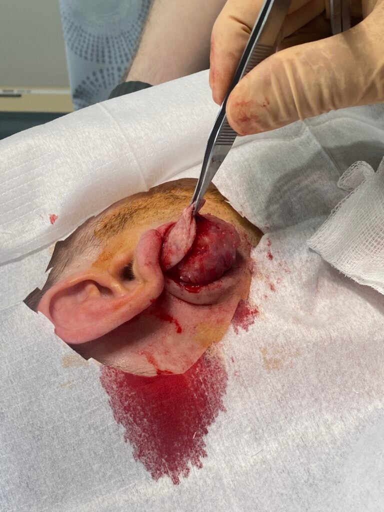 large cyst dissected out