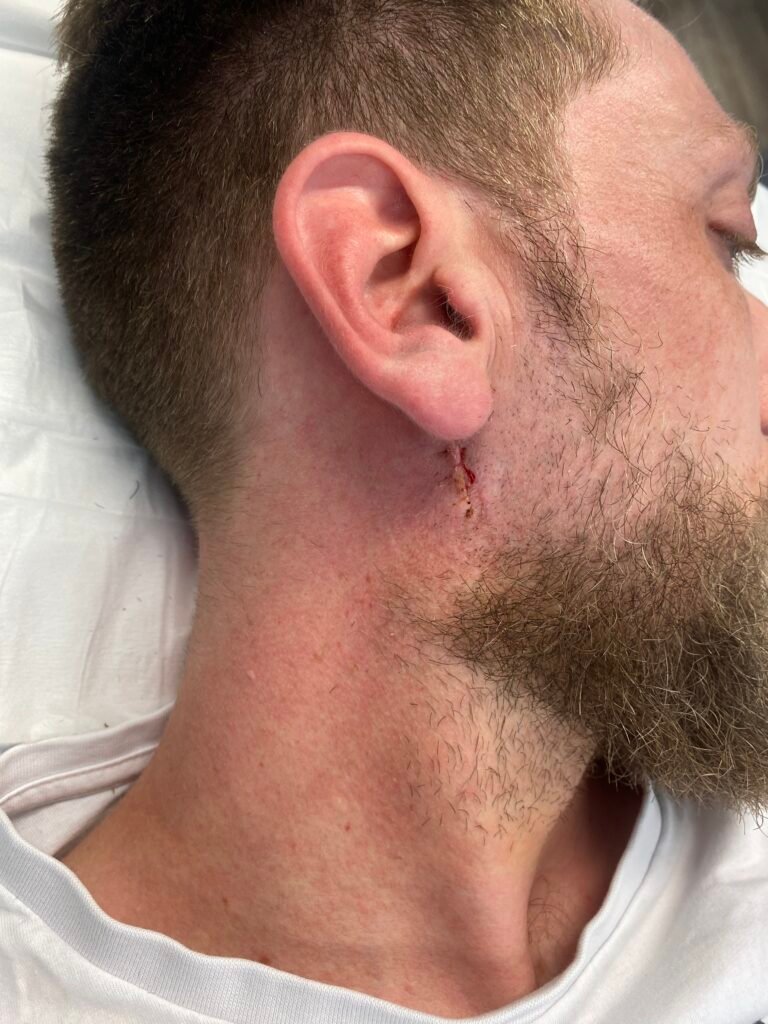 large cyst removed 1 week