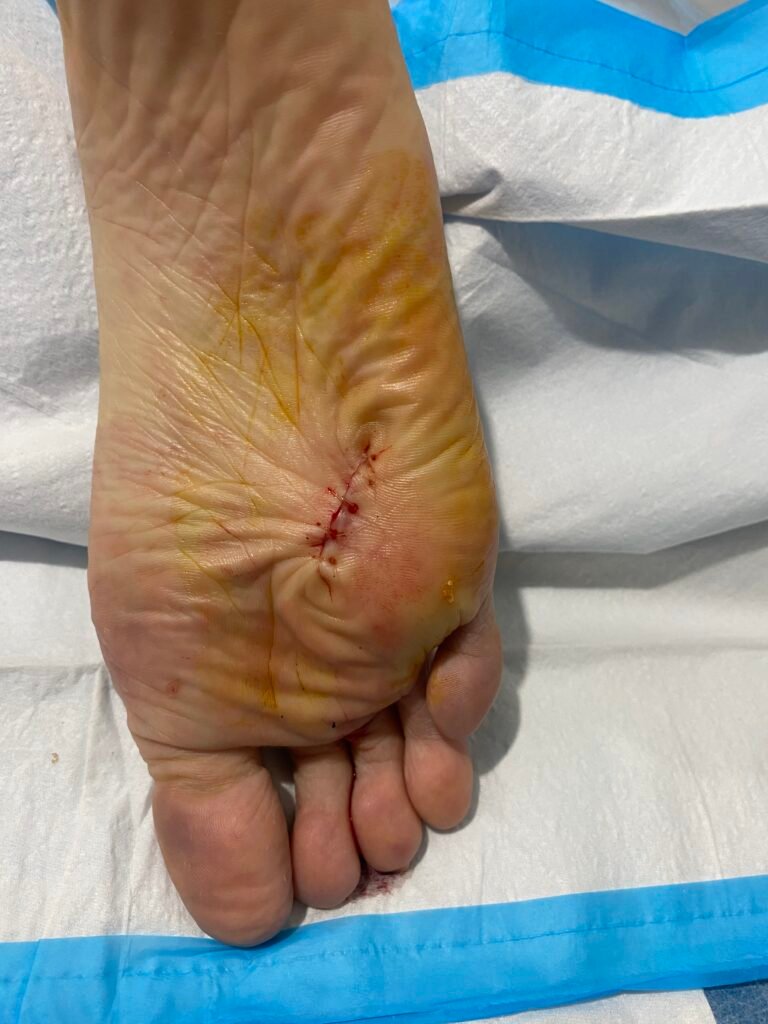 growth removed foot