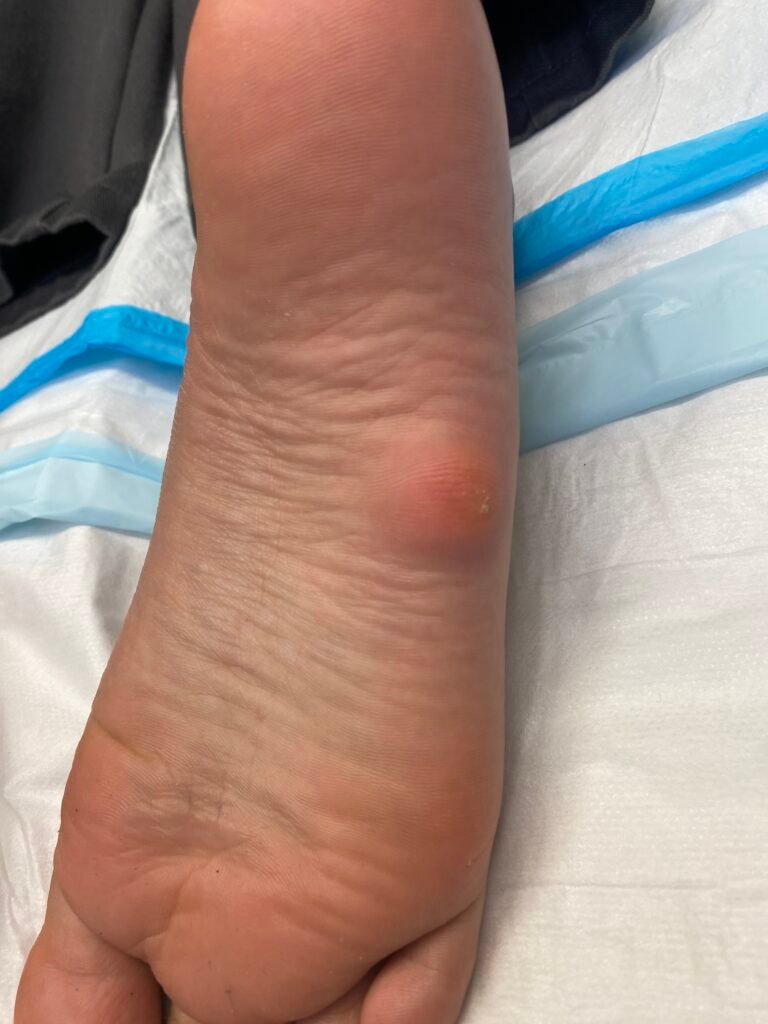 lipoma foot