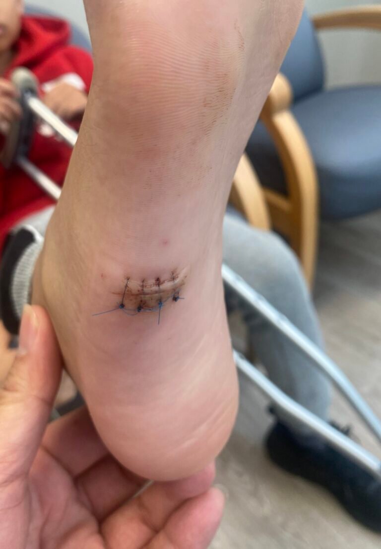 lipoma foot removed closed with heavy suture