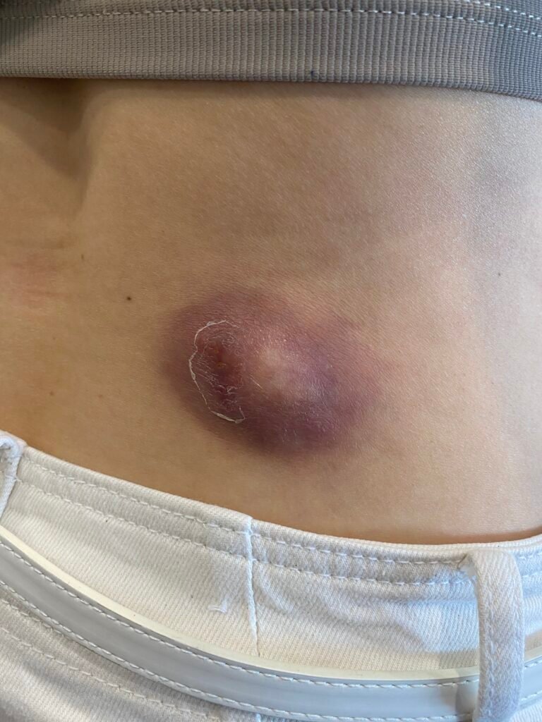 infected cyst on the back