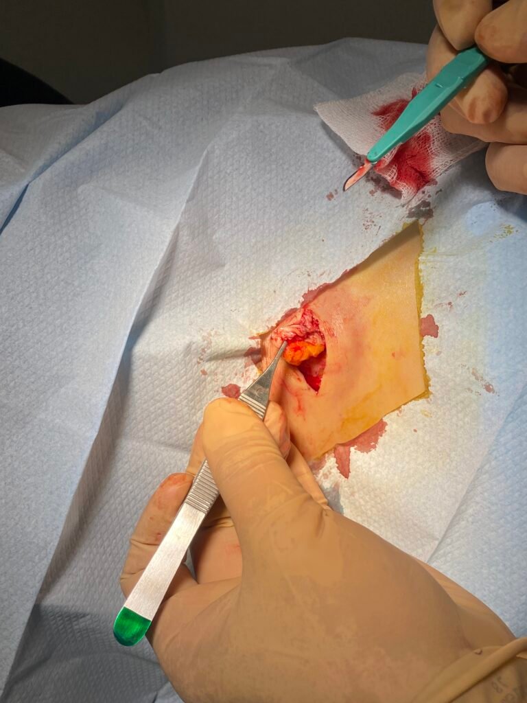 cyst dissected out